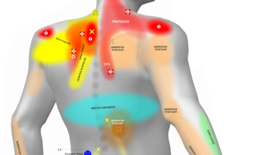 How to Understand and Treat Back Pain Using a Body Map