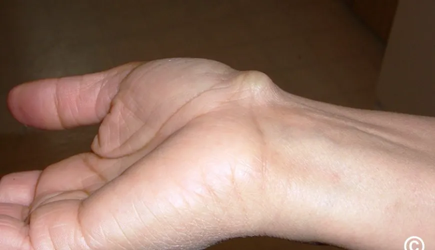 How to effectively get rid of an unpleasant ganglion?