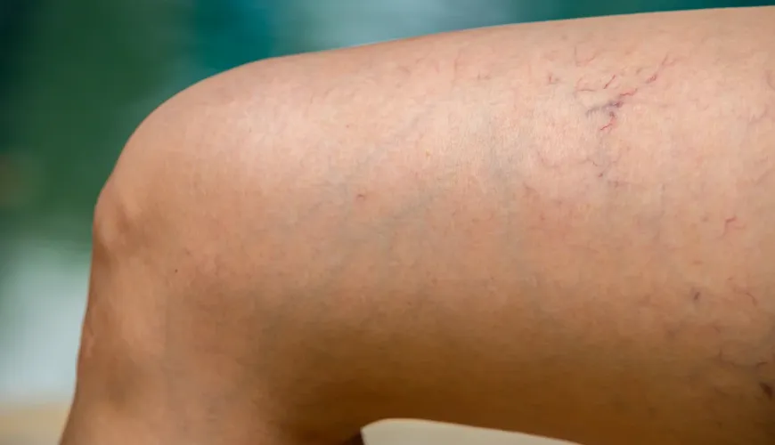 How to Get Rid of Spider Veins Using Modern Methods