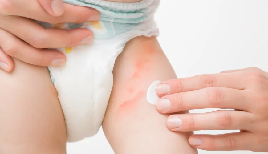 How to Prevent Diaper Rash and Keep Skin Healthy