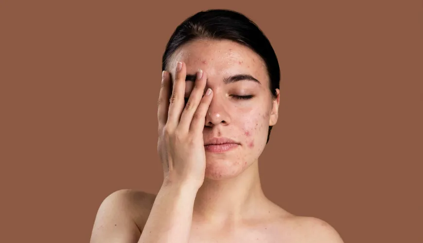 How to Get Rid of Painful Subcutaneous Lumps from Acne