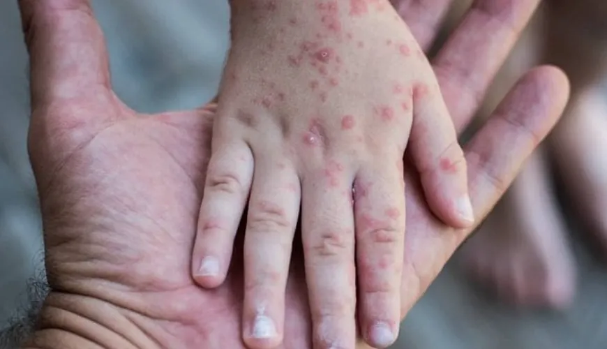 Seventh disease in children and its main symptoms