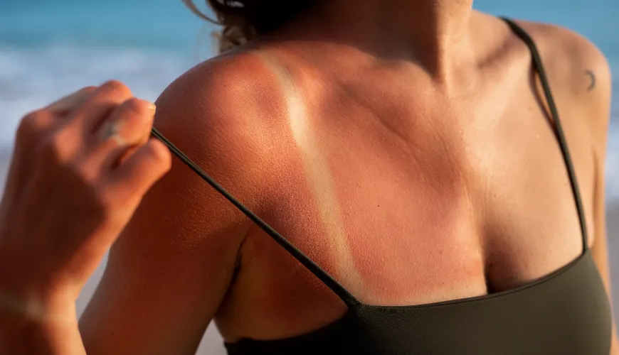 How to Avoid Sun Rash and Enjoy Sunny Days?