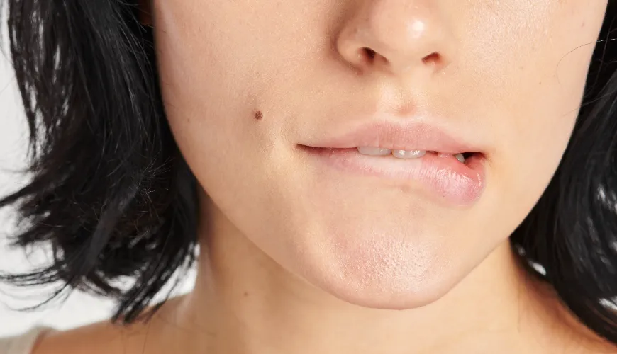 Causes of Chin Acne and How to Permanently Remove It