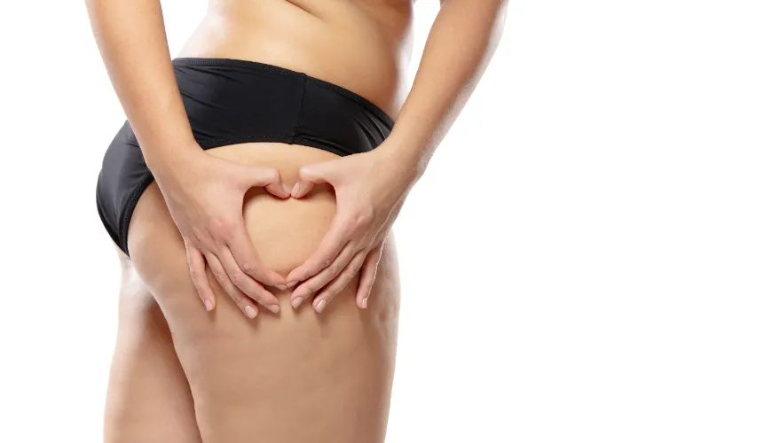 How cellulite forms and what affects its visibility