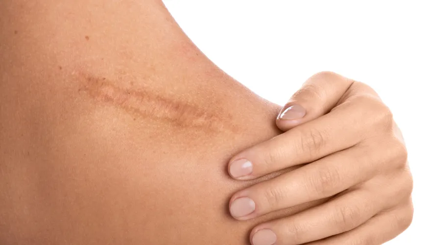 Get Rid of Scars with Proven Scar Wonders