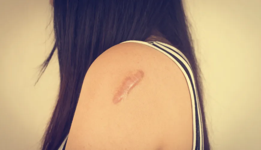 The Best Methods for Treating Keloid Scars