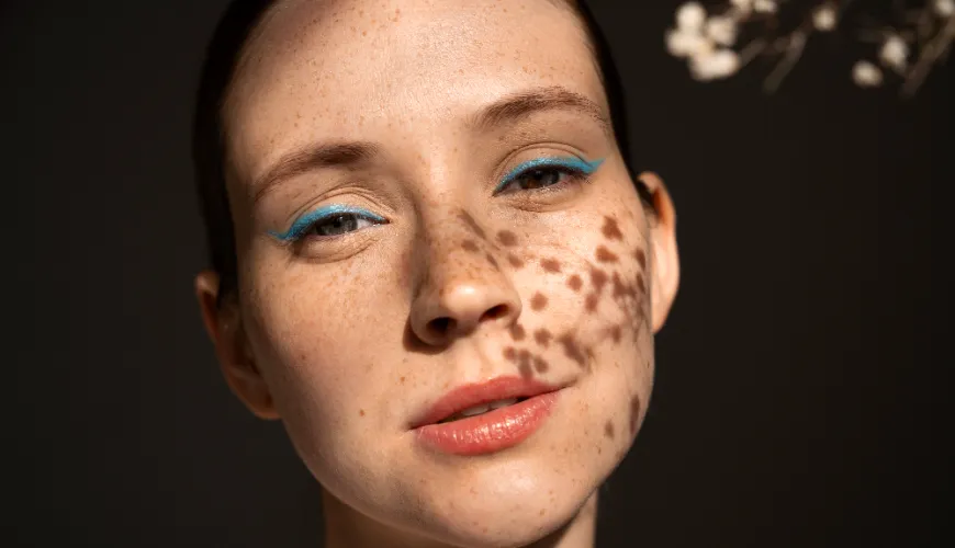 How to Quickly Get Rid of Pigment Spots